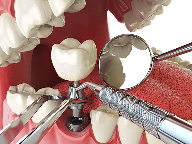 Best Emergency Root Canal Treatment in Little River, SC